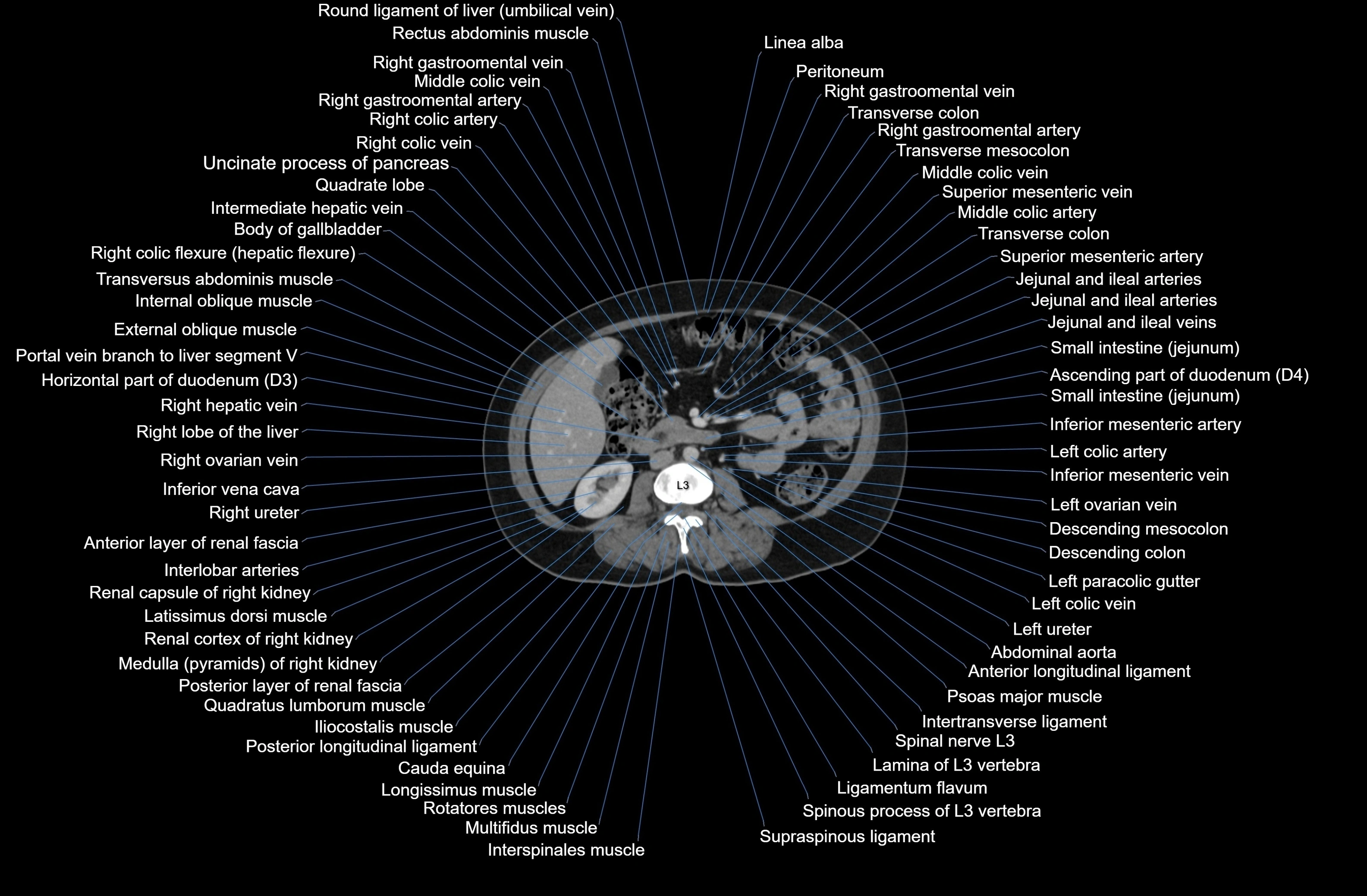 CT Abdomen axial cross sectional anatomy labelled radiology image-00045.webp